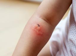 모기 물린 곳 퉁퉁 붓는 "스키터증후군" 연고와 증상, 원인, 치료법 정리  썸네일