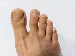 발톱무좀약 '주블리아' 효과, 사용법, 가격, 부작용, 처방받는 법까지! 썸네일