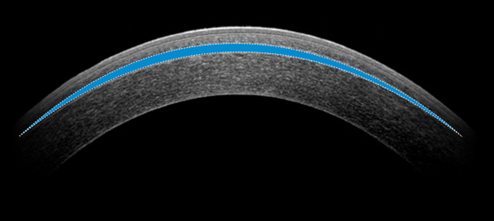 스마일라식수술주의사항
