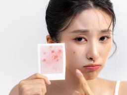 화농성·염증성 여드름으로 고민이라면? 바르는 여드름 항생제 성분 확인하기 썸네일
