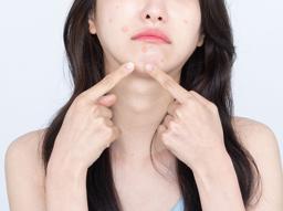 "여드름 흉터, 효과적인 치료법은?" 원인과 종류, 치료 방법 썸네일