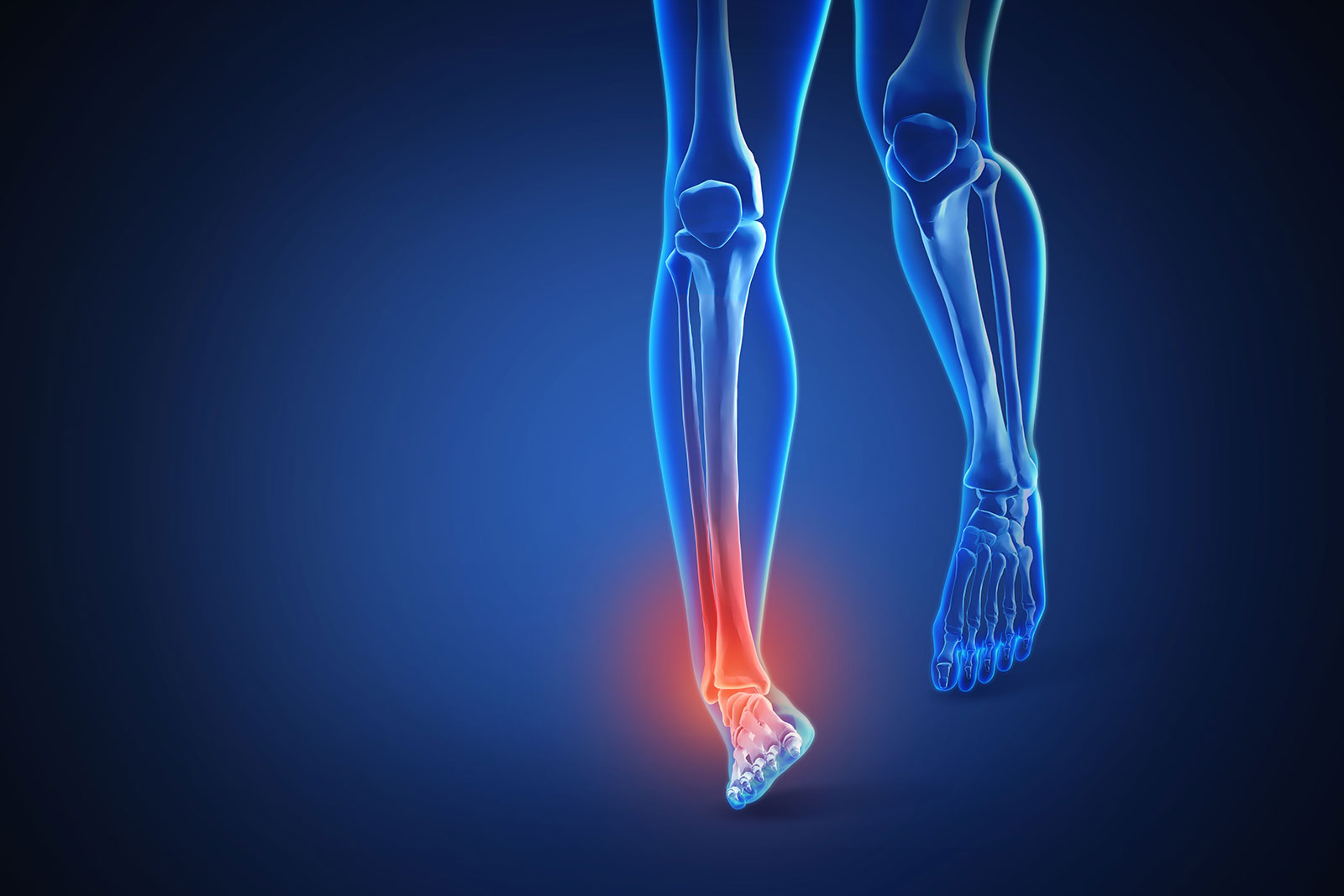 親指の捻挫のグレード