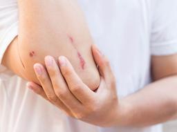 녹슨 철에 긁혔는데 파상풍일까? 파상풍 초기 증상과 치료법 알아두세요  썸네일