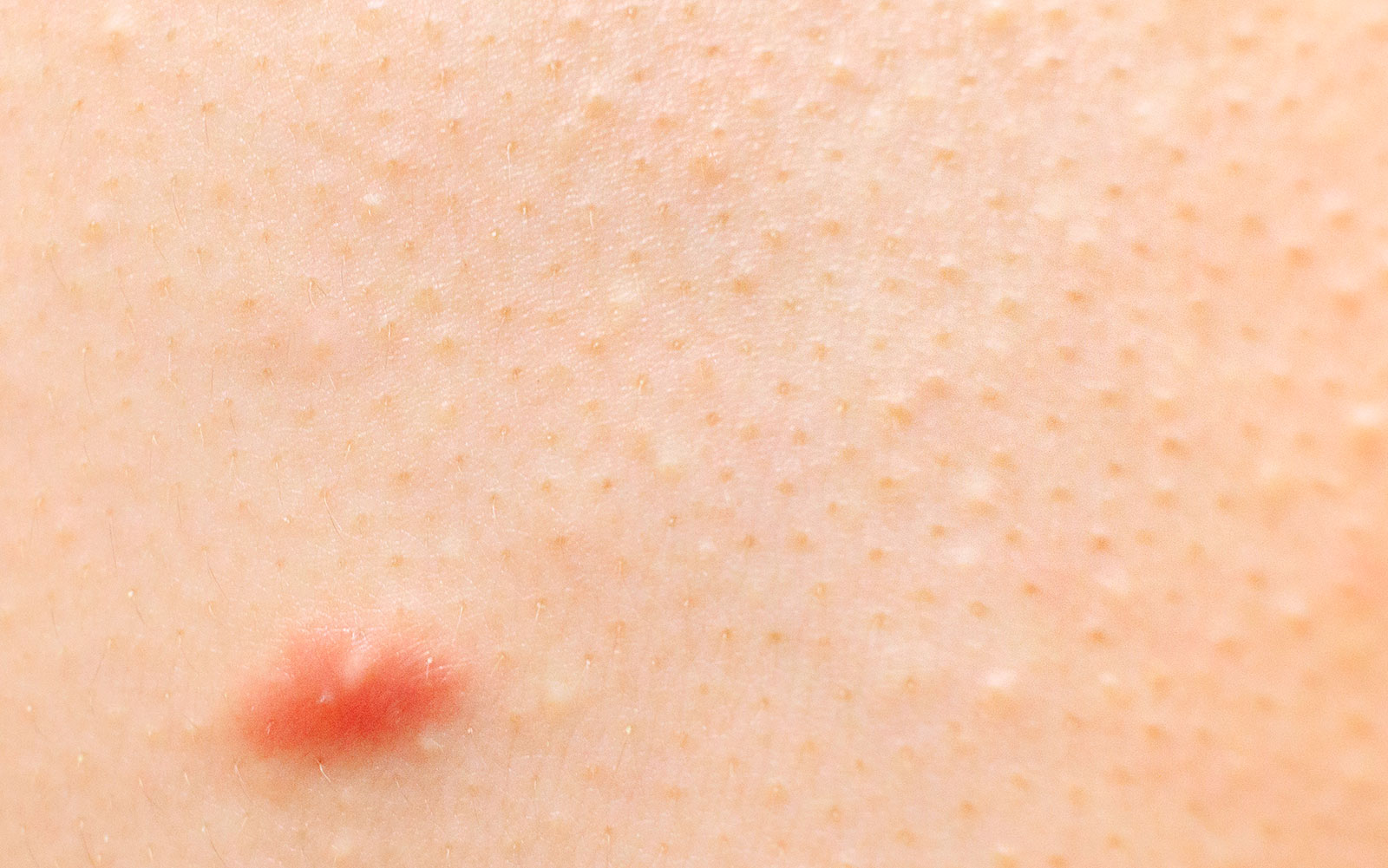 毛孔性角化症のレーザー治療とは何ですか?