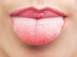 "혓바늘" 생기는 원인부터 빨리 낫는 법은?  썸네일
