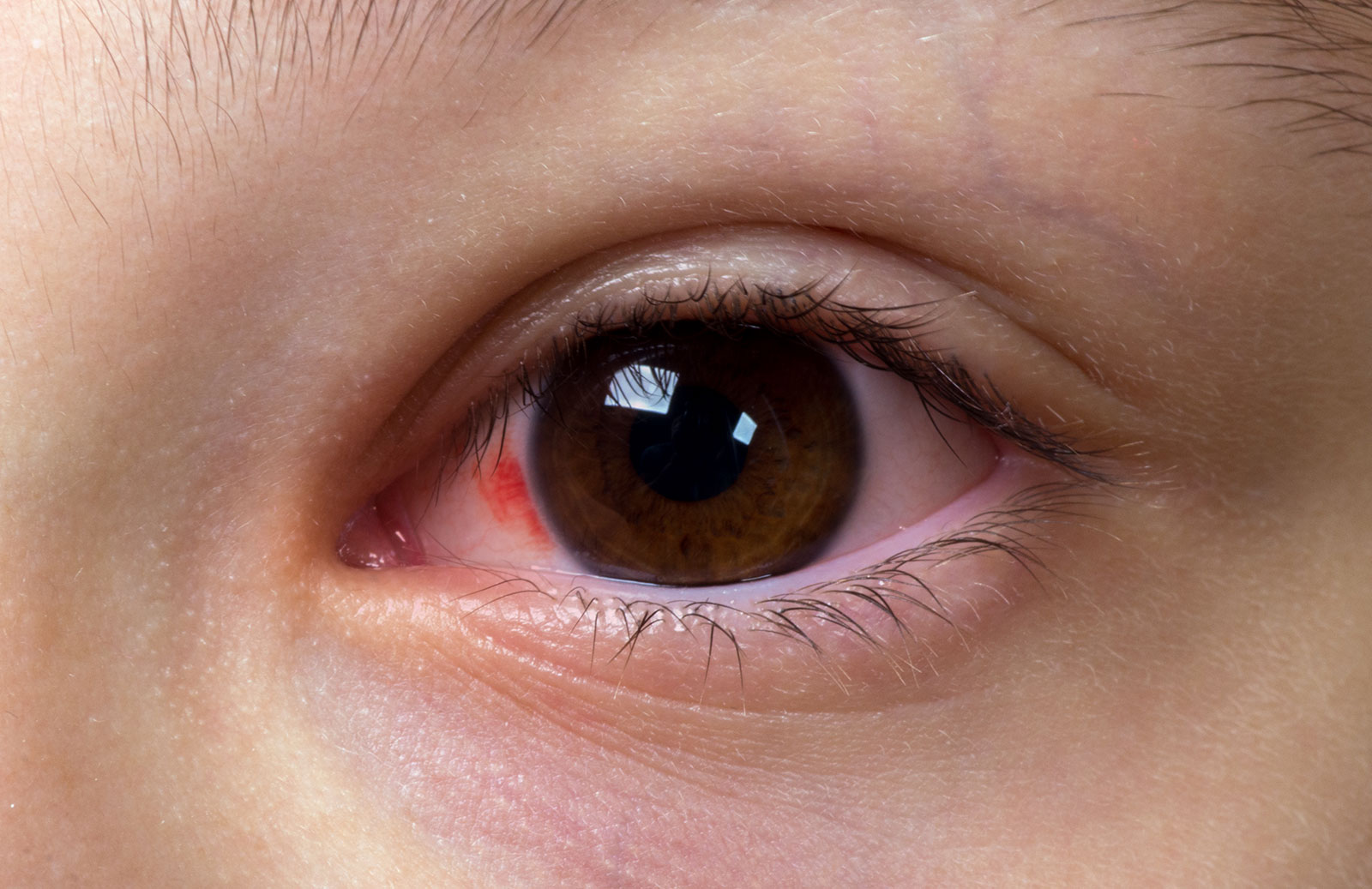  SANS の原因は何ですか?