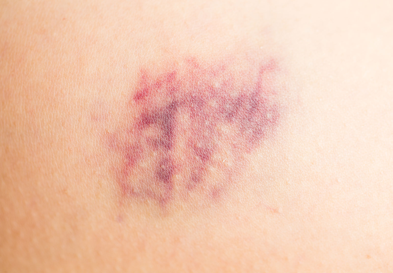 滲出性湿疹の症状は何ですか?