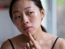 "아다팔렌, 효과 있나요?" 여드름 치료제 아다팔렌의 효과, 부작용, 주의사항 썸네일