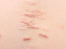 [1분 FAQ] 대상포진에 걸리면 어떻게 치료하나요? 썸네일