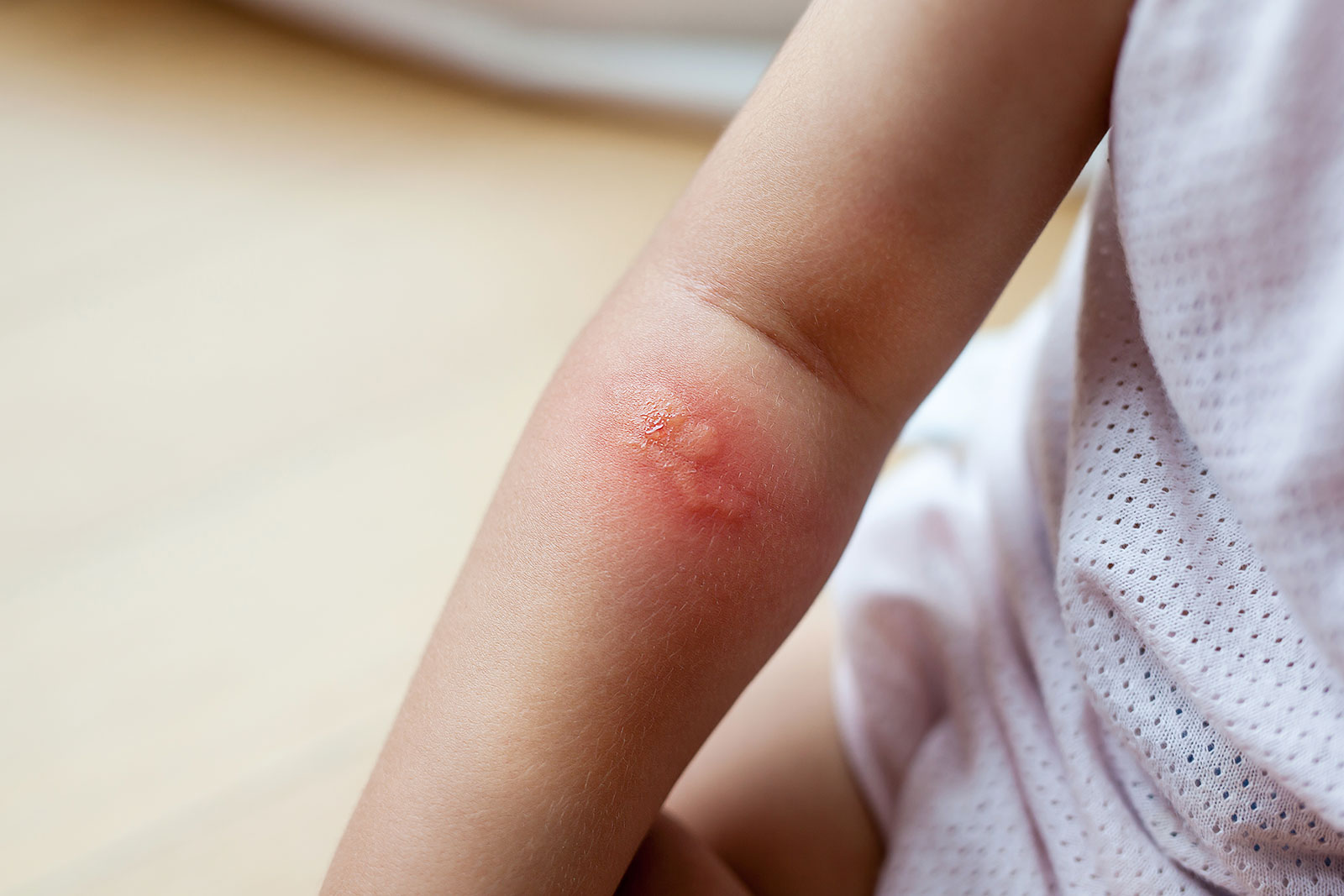 頬部の発疹はどのようなものですか?