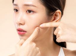 "이소티논 부작용 심한 편인가요?" 먹는 여드름 약 이소티논 부작용, 효과, 복용법 썸네일